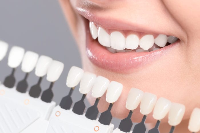 dentist in hunt valley md for teeth whitening