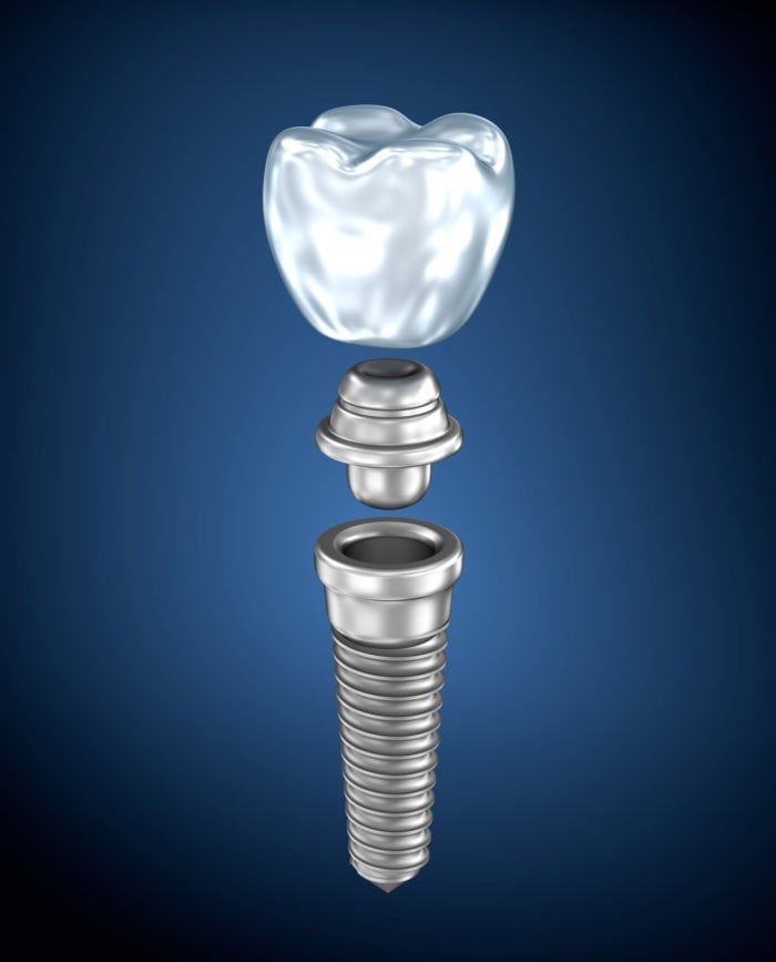 Dental Implants Hunt Valley, Maryland